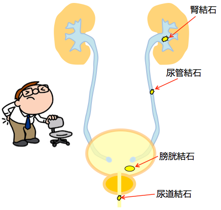 結石 尿 女性 路