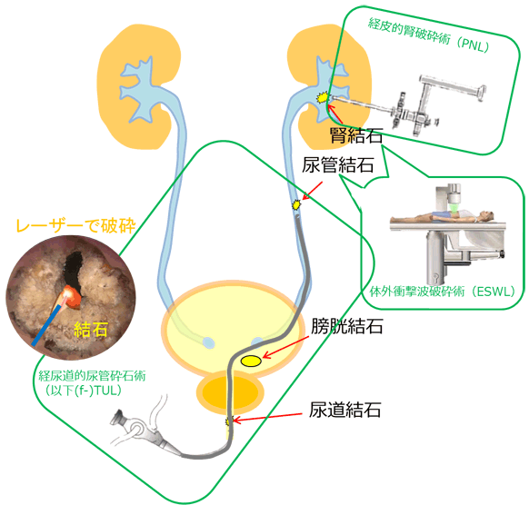 腎臓 結石 症状 血尿