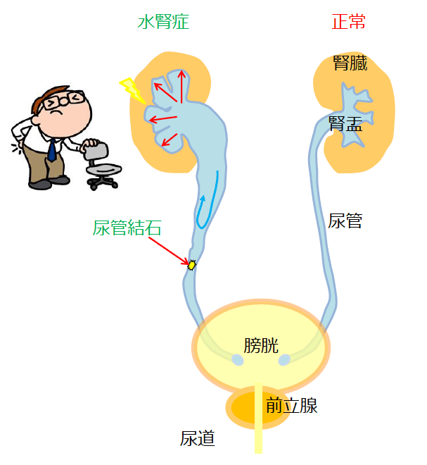 嚢胞 エコー 腎 腹部超音波検査 腎臓３