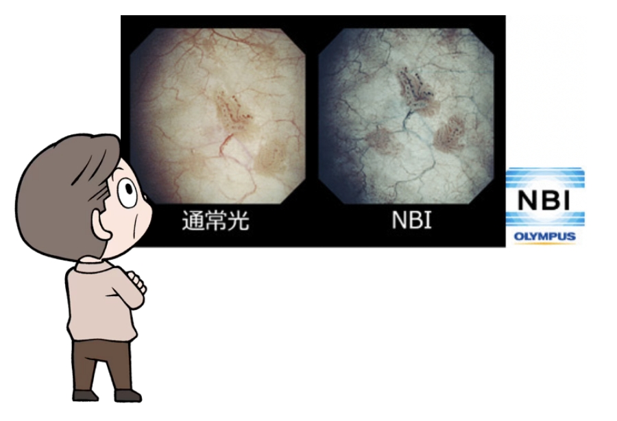 通常光とNBI（狭帯域光観察）の比較