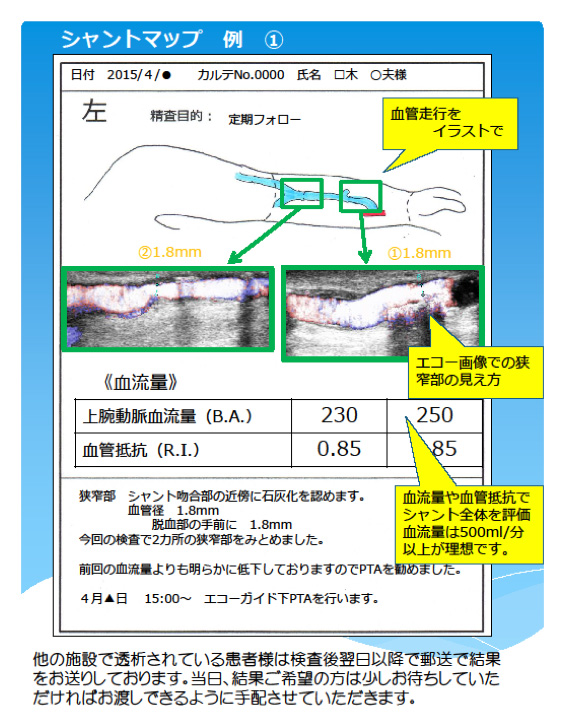 シャントマップ例 - 1