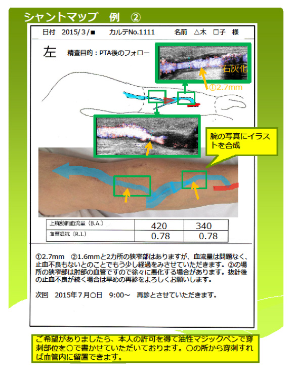 シャントマップ例 - 2