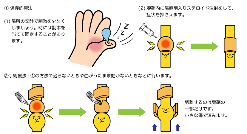 ばね指手術 透析アミロイドーシス 阿佐谷すずき診療所