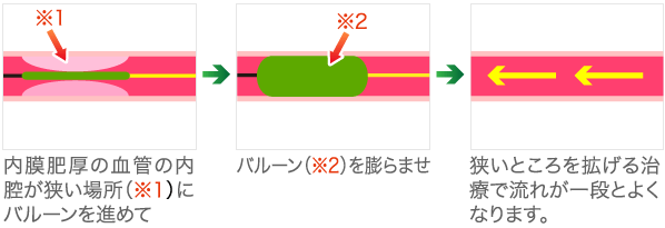 pta とは 血管