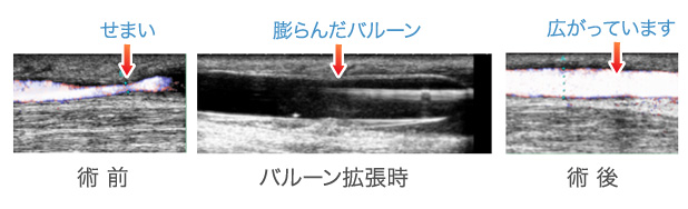 Pta シャント